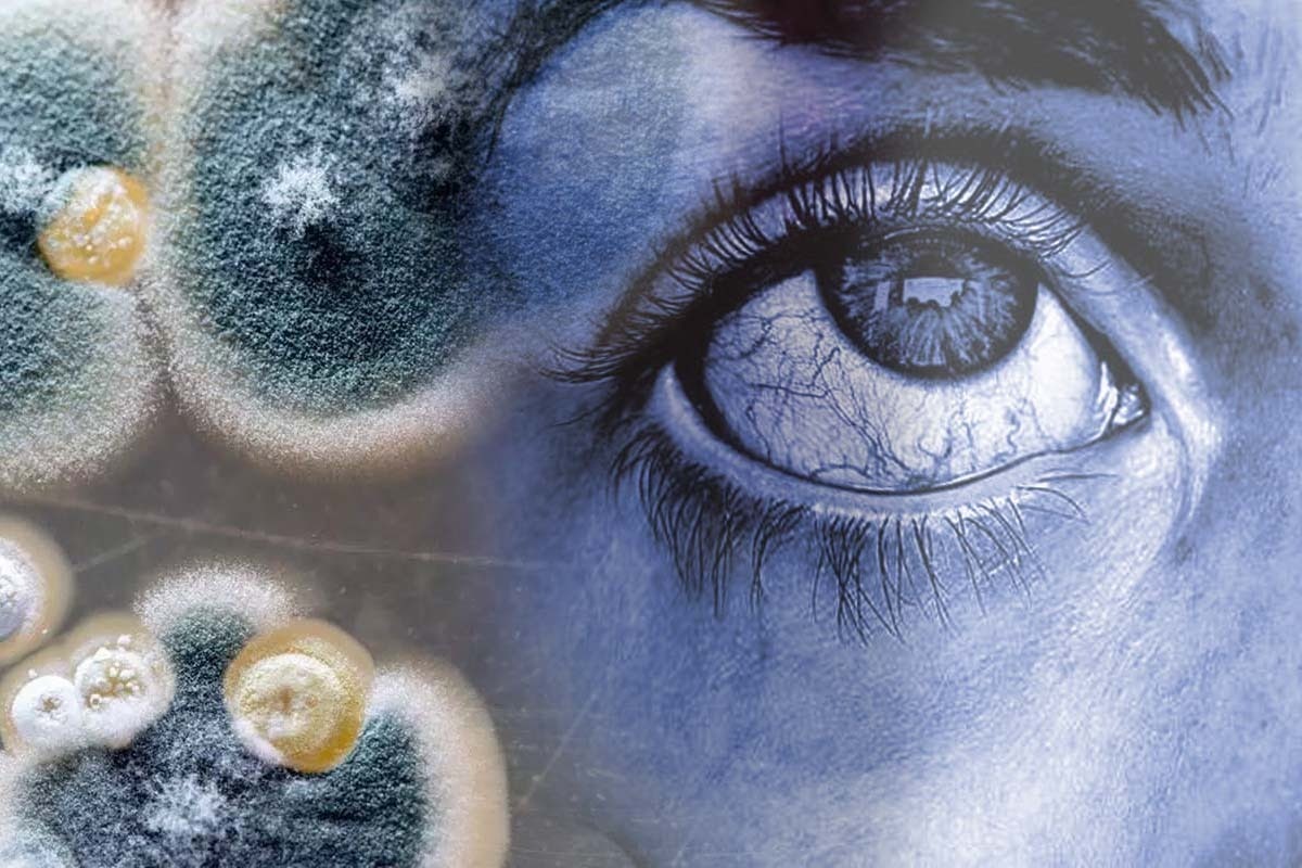 Mais 3 casos de Mpox são confirmados no Amazonas; Manaus lidera ranking