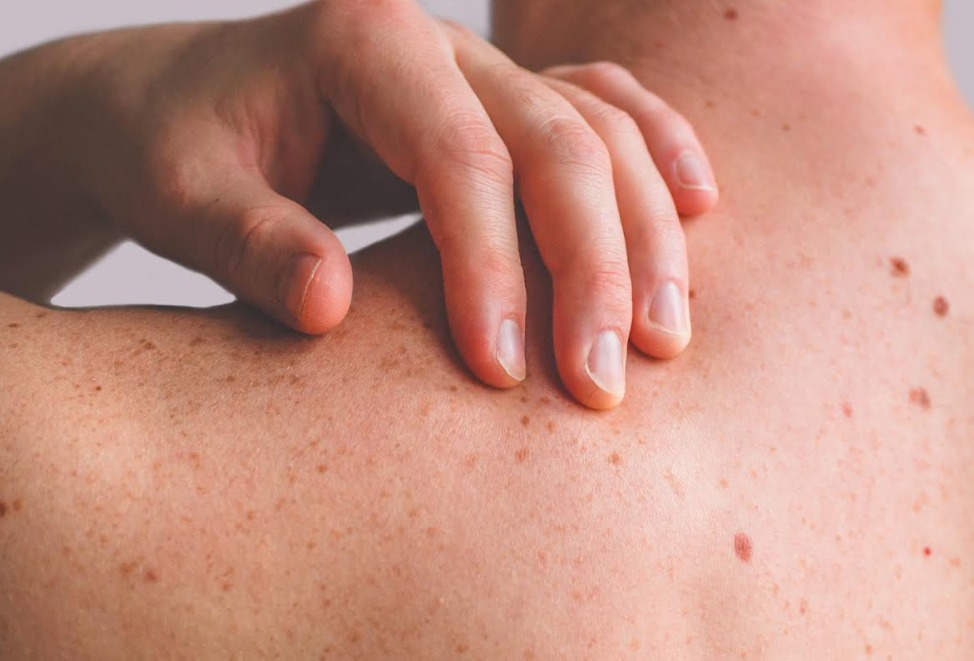 Dezembro Laranja: Saiba quem está mais vulnerável a ter câncer de pele