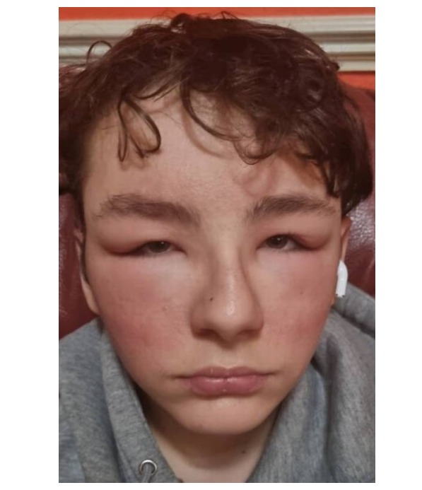 Adolescente tem rosto deformado após reação alérgica a óculos de videogame