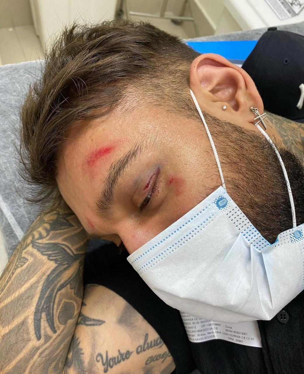 Lucas Lucco aparece em foto com fratura e olho roxo: “bebi demais”