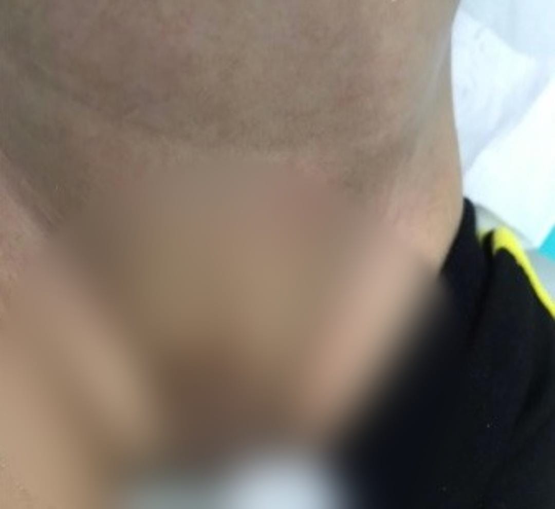 Em caso raro, bebê nasce sem pênis e faz xixi pelo ânus