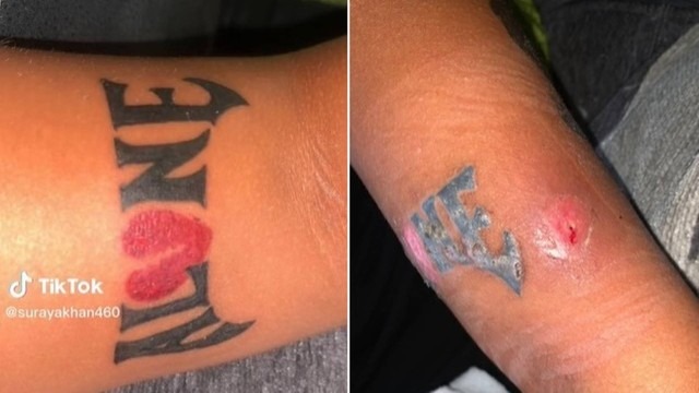 Braço de jovem ‘apodrece’ após tatuagem