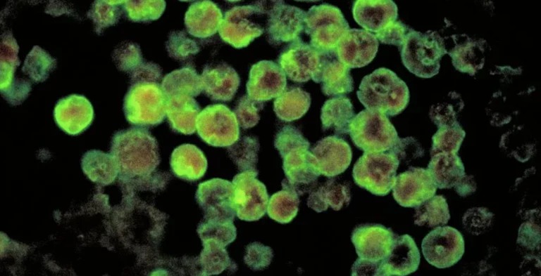 Homem morre após contrair ameba ao lavar o rosto