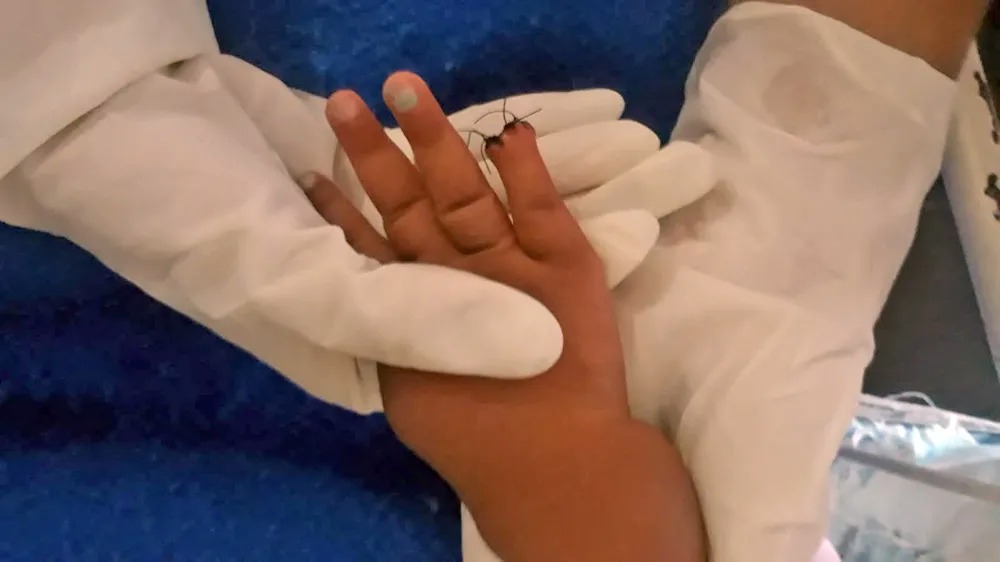 Bebê é internada por picada de inseto e acaba com dedo amputado