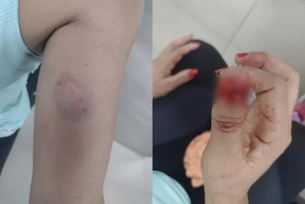 Treinadora arranca unha de aluna durante briga em academia