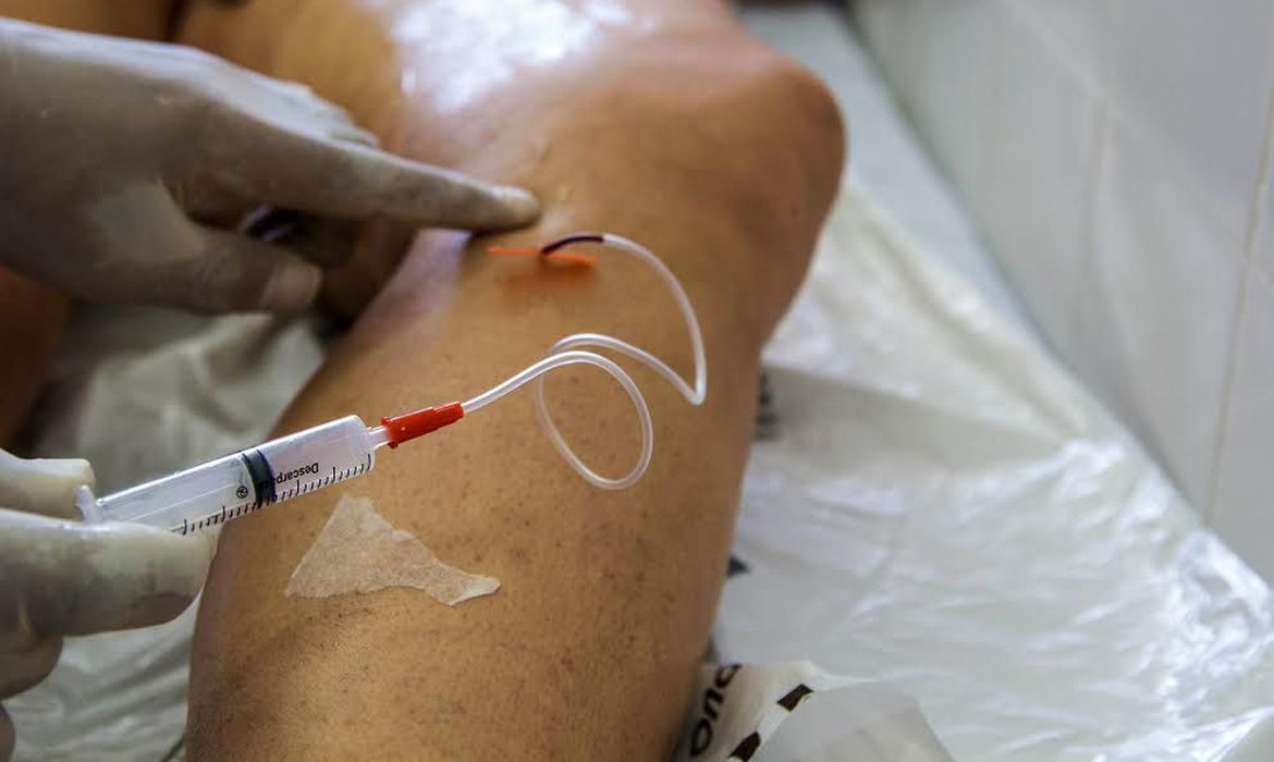 No Brasil mais de 45 mil mulheres foram internadas por varizes em 2022