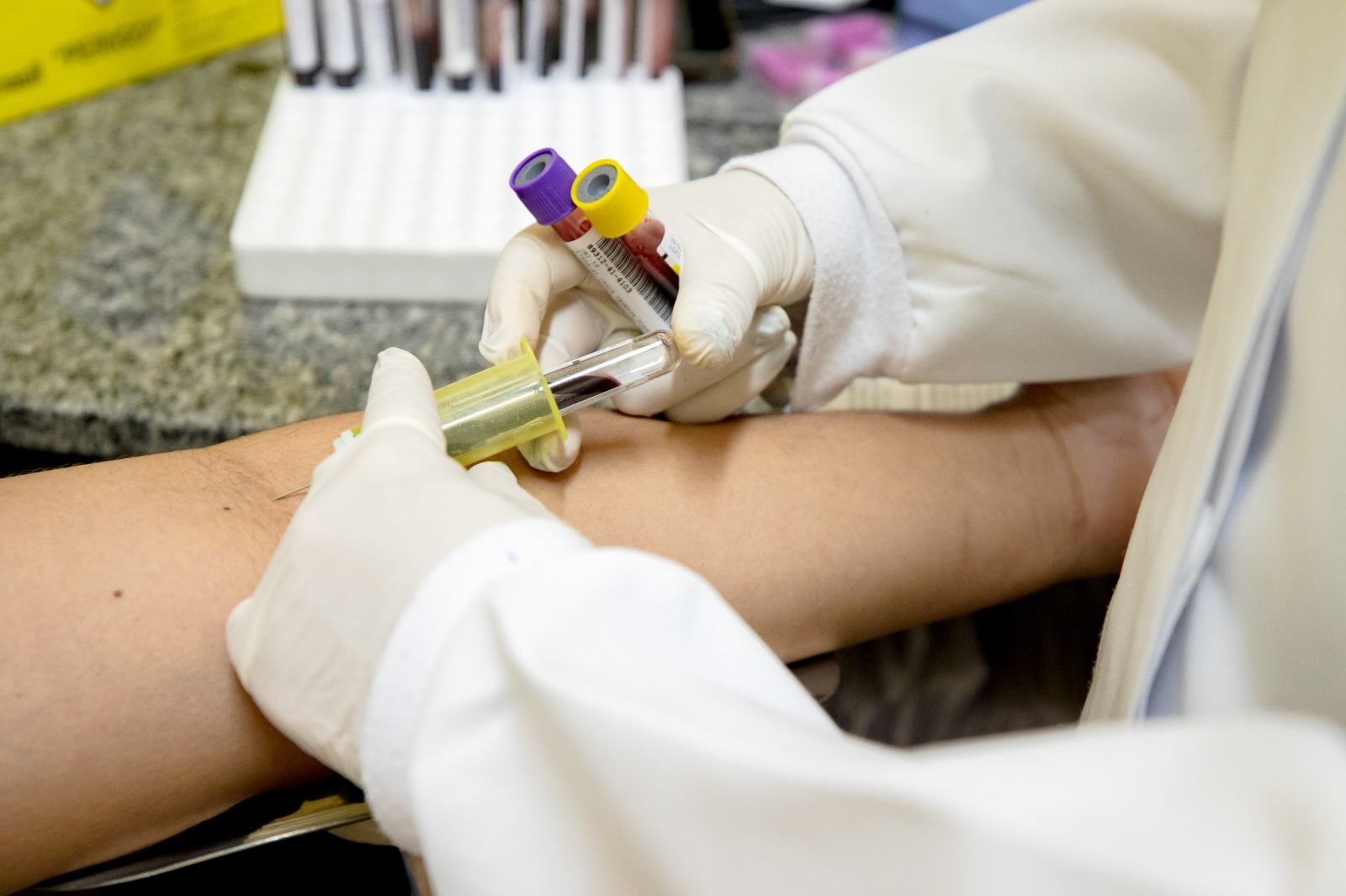 Manaus inicia oferta de novo teste para diagnosticar tuberculose latente