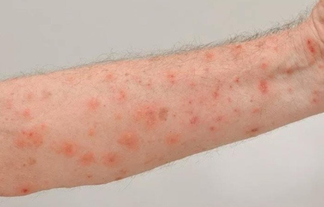 Surto de sarna atinge refugiados afegãos no Aeroporto de Guarulhos