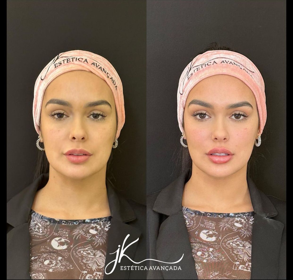 Ex-BBB Larissa Santos faz harmonização facial e resultado surpreende