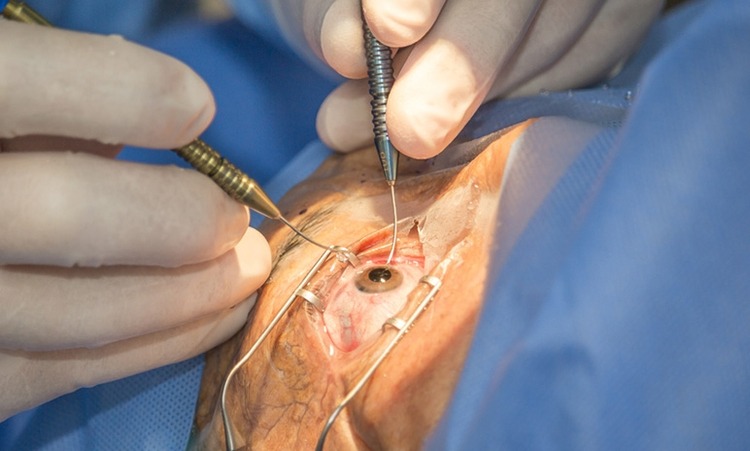 Manaus tem mutirão de cirurgias de cataratas neste fim de semana