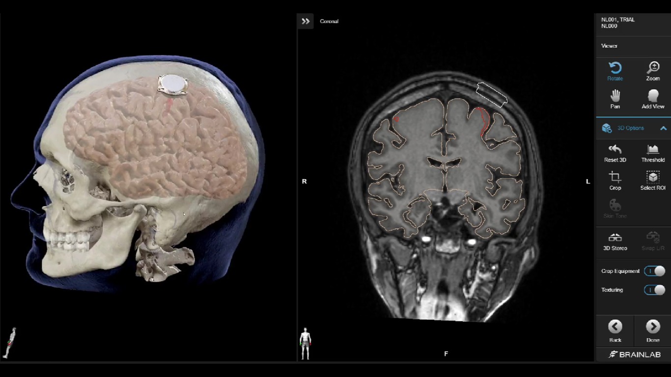 Chip cerebral de Elon Musk é implantado em humano pela primeira vez