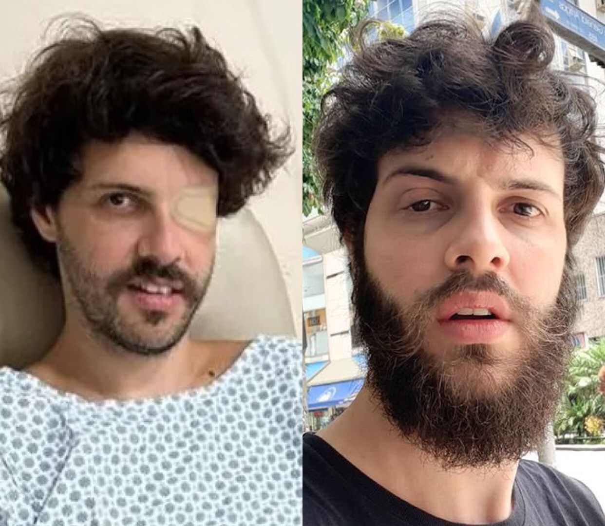 Diogo Defante faz cirurgia no olho caído e avisa: 'fim de uma era'