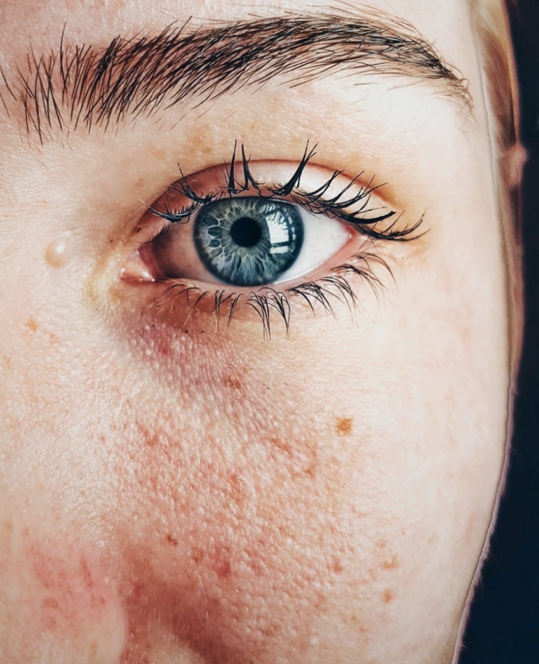 Câncer de pele: aprenda a identificar pintas suspeitas