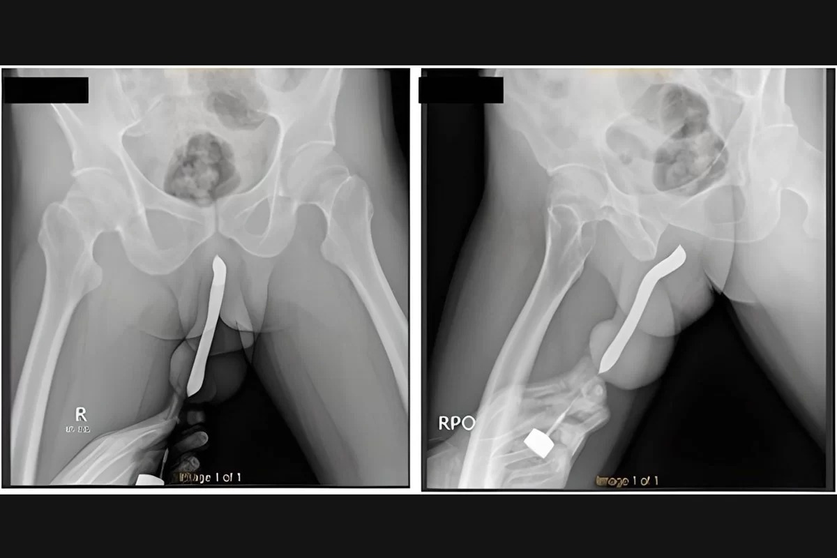 Homem enfia escova de dentes no pênis e vai parar no hospital