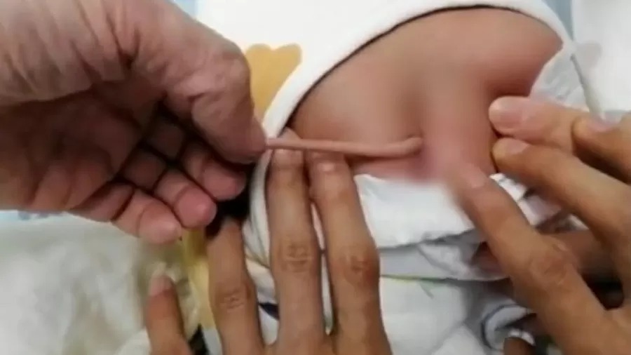 Bebê nasce com ‘cauda’ de 10 cm; entenda condição rara