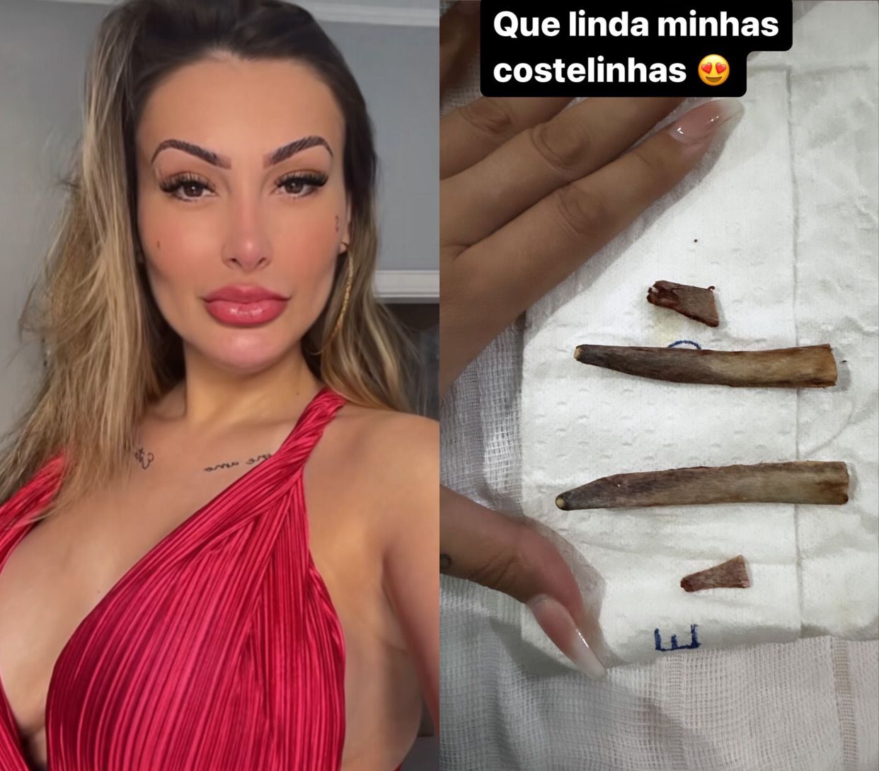 Andressa Urach posta foto das costelas retiradas: 'que lindas'