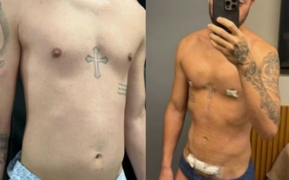 Rico Melquiades, campeão de A Fazenda, mostra resultado de lipoaspiração