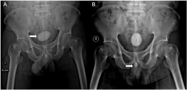 De chip a cabo elétrico: Homem enfia objetos no pênis e vai parar em hospital