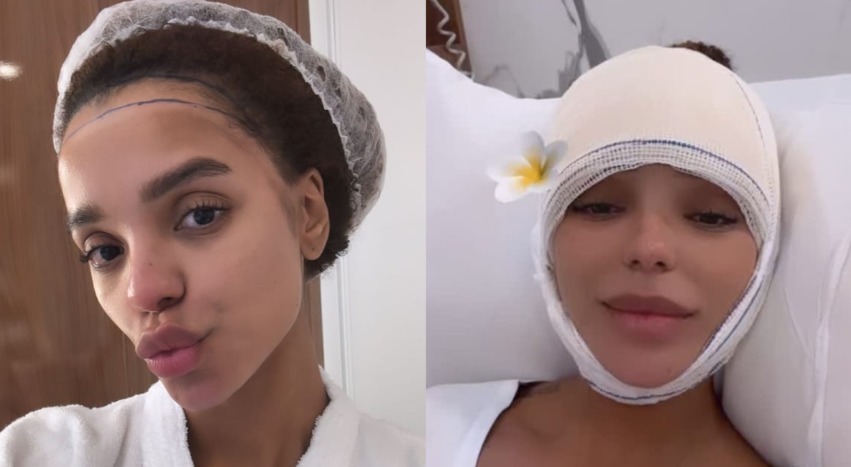 Brunna Gonçalves faz cirurgia para reduzir testa: 'realizei um sonho'