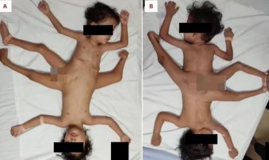 Gêmeos nascem com três pernas e quatro braços após gravidez 'normal'