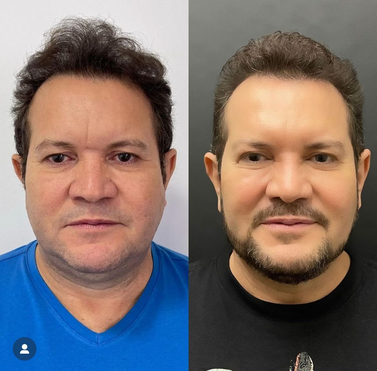 Ximbinha faz harmonização facial; veja antes e depois