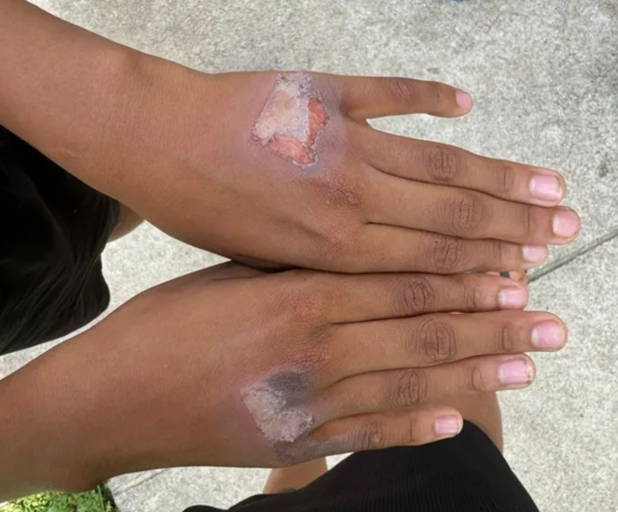 Mulher queima as mãos do filho de 10 anos com chapinha por causa de iogurte