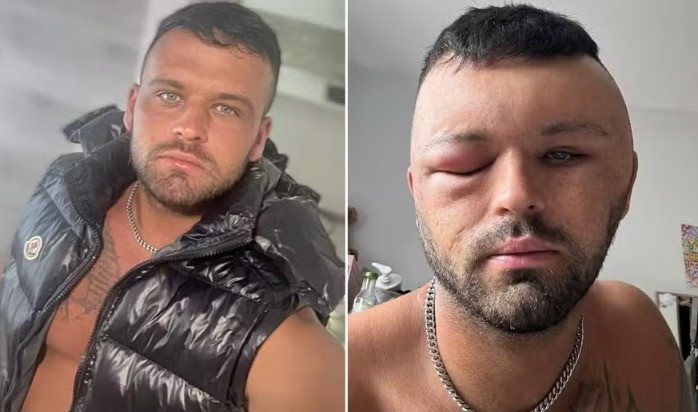 Homem fica com a 'cabeça gigante' após reação alérgica a tinta de cabelo
