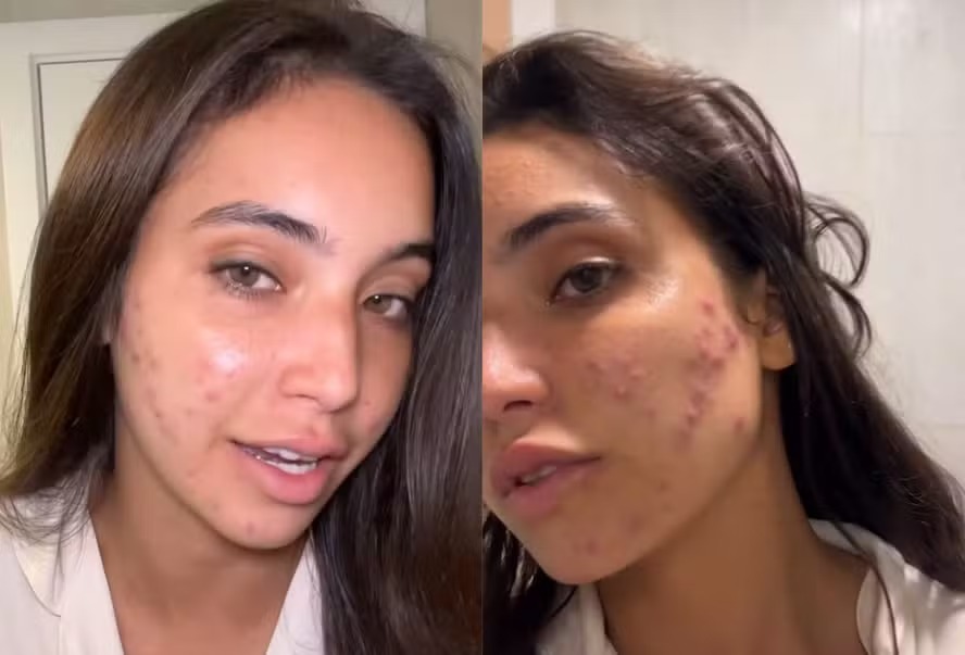 Vanessa Lopes mostra rosto com acne e desabafa sobre saúde mental