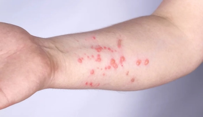 Brasil supera marca de mil casos de mpox em 2024