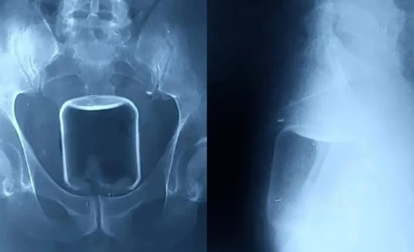 Homem passa por cirurgia para retirar copo de vidro do ânus 