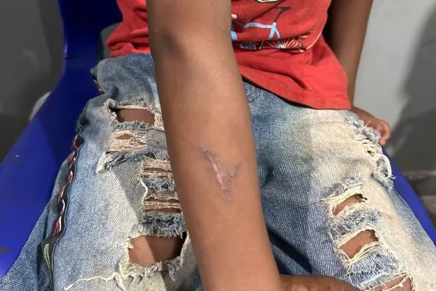 Pecuarista queima braço de criança indígena com ferro de marcar gado