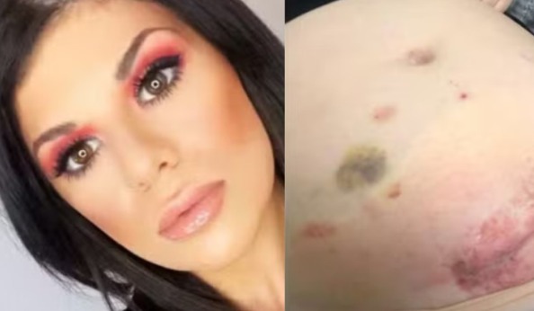 Australiana descobre cinco órgãos a mais no corpo após dores intensas