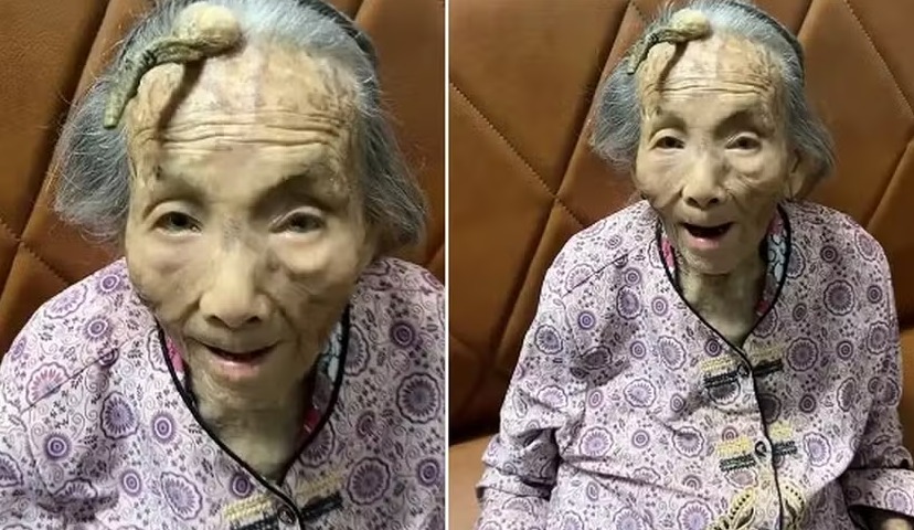 Idosa de 107 anos chama atenção com chifre de 10cm