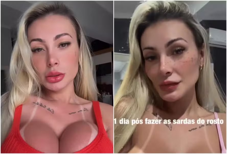 Andressa Urach mostra antes e depois de tatuar sardas no rosto