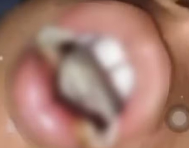 Avó é presa após castigar neto de 10 anos com ovo quente na boca