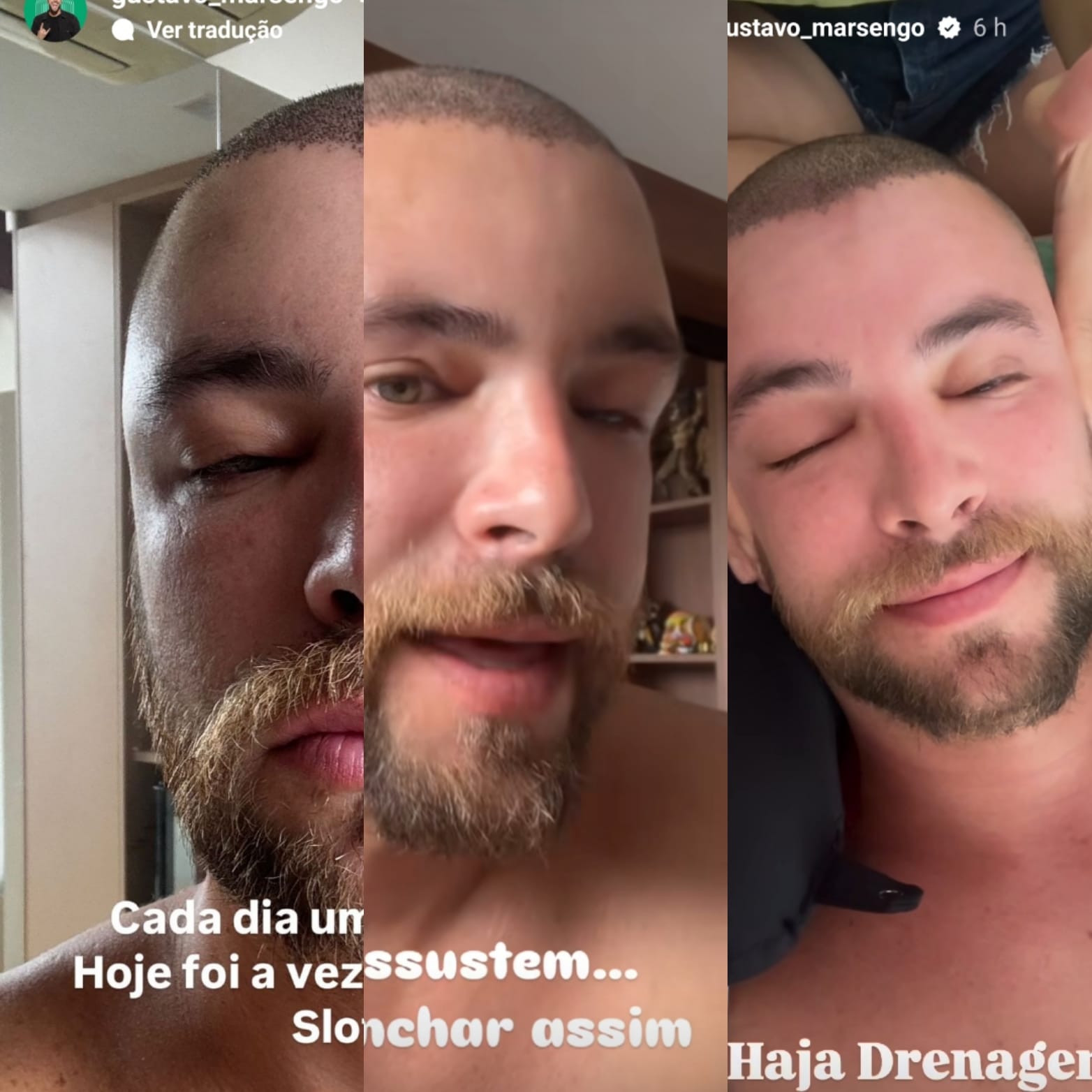 Ex-BBB Gustavo Beats aparece irreconhecível após transplante capilar 