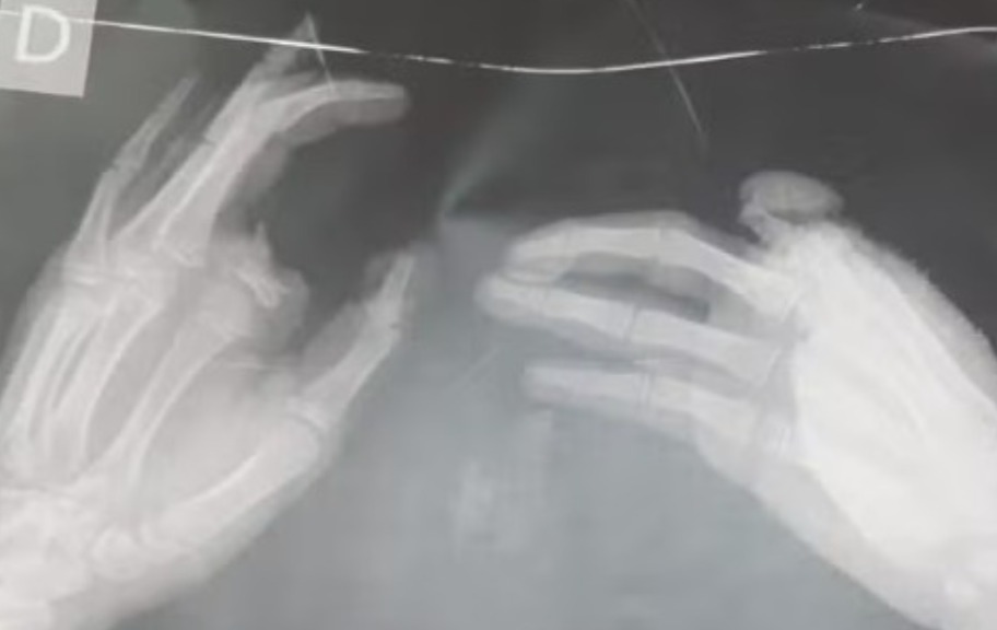 Criança perde dedo após explosão de bomba que encontrou na sede do Sport