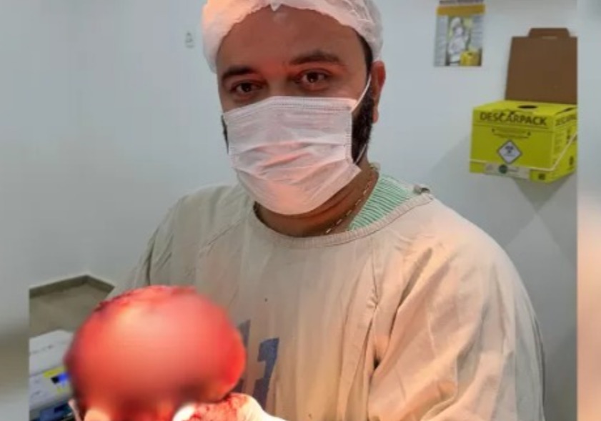 Médico mostra extração de tumor gigante de quase 2 kg