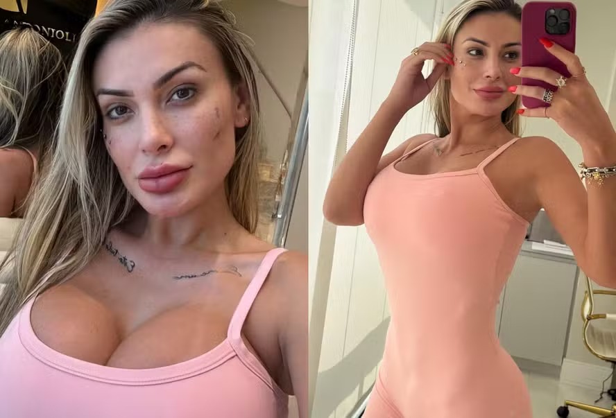 Andressa Urach faz rejuvenecimento íntimo: "Não vejo a hora de mostrar"