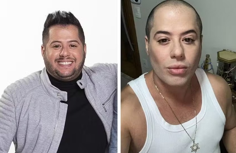 Hugo, da dupla com Tiago, surge irreconhecível após harmonização e lipo