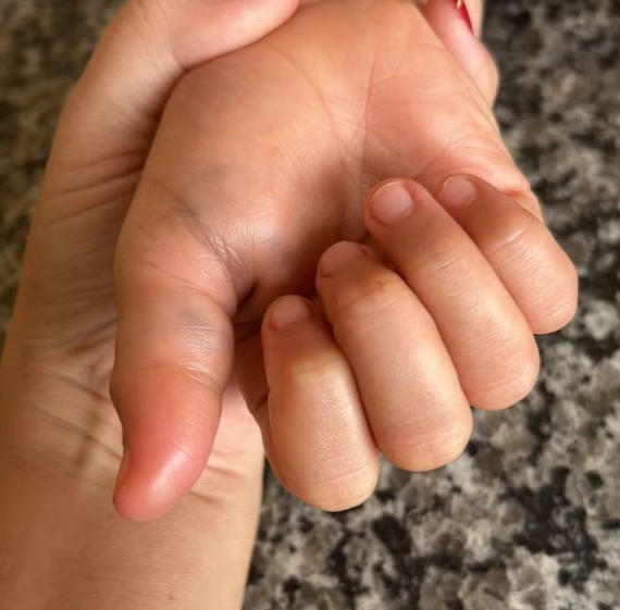 Criança tem dedo quebrado após ser espancada pela madrasta