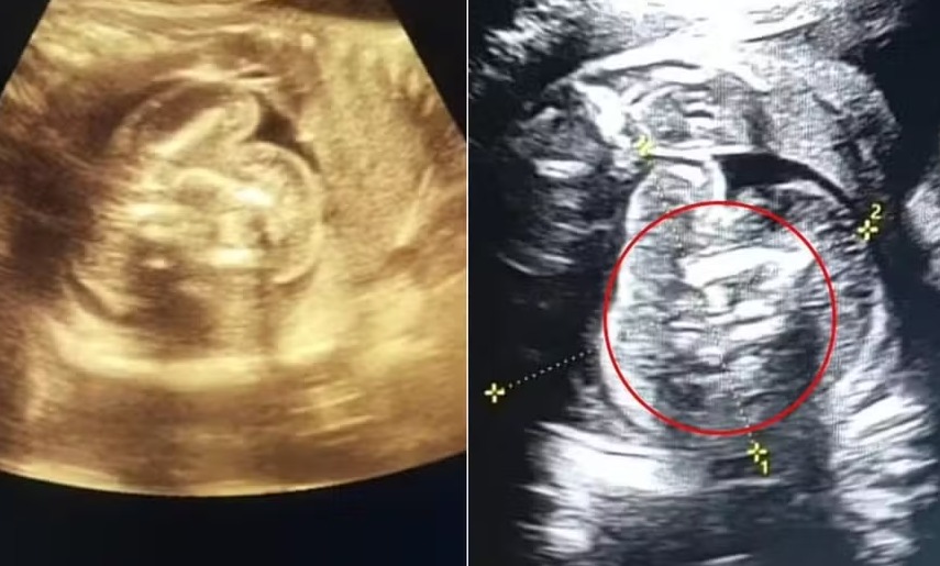 Bebê nasce com dois fetos dentro da barriga em caso raro