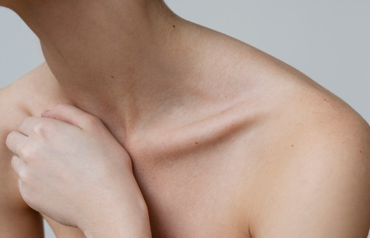 Mulher sofre AVC após chupão no pescoço