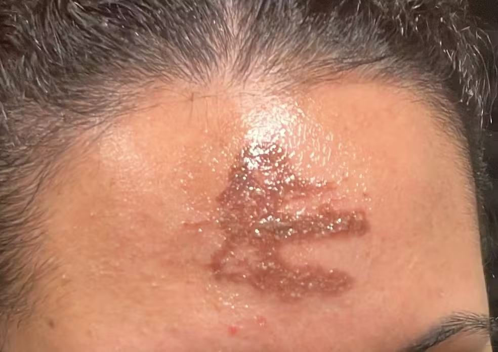 Fiéis sofrem queimaduras com cinzas da Quaresma em missa