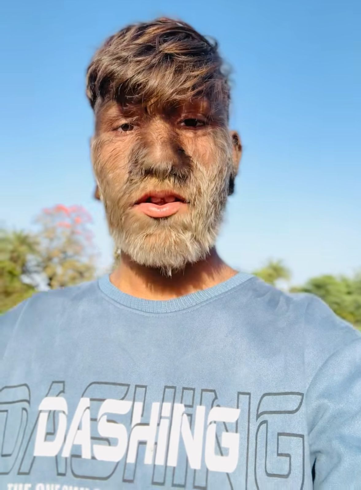 Adolescente da Índia quebra recorde no Guinness por ter o rosto mais peludo