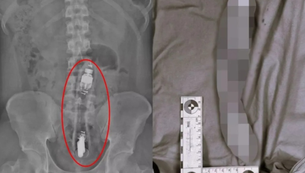 Vibrador ligado é encontrado dentro de ânus de paciente durante cirurgia  