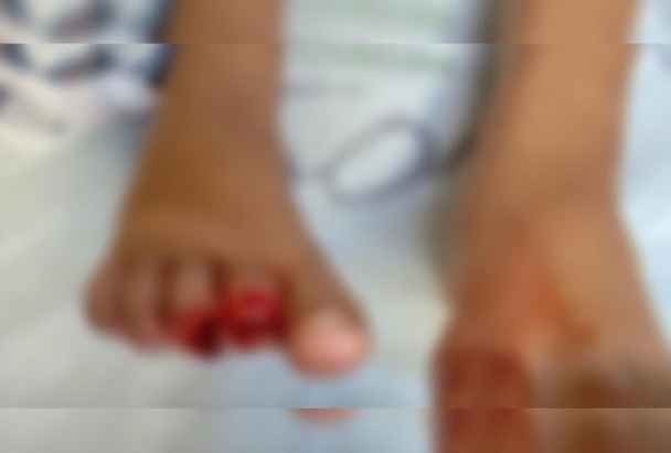 Menino de 9 anos tem dedos arrancados por piranhas em lago de Goiás