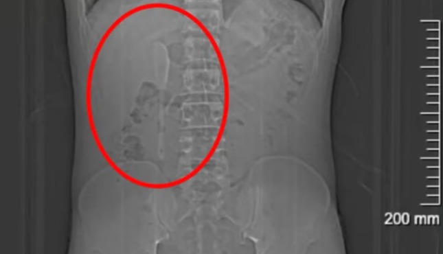 Achou que era um sonho: homem descobre colher no intestino após cinco meses