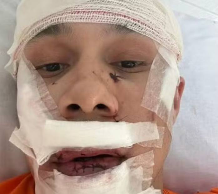 Após defender mulheres, personal é agredido e leva 45 pontos no rosto em SP
