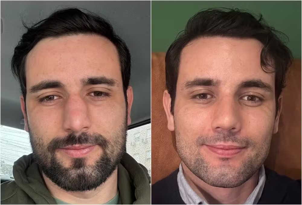 Ex-bbb Matteus Amaral mostra resultado de cirurgia plástica no nariz; vídeo